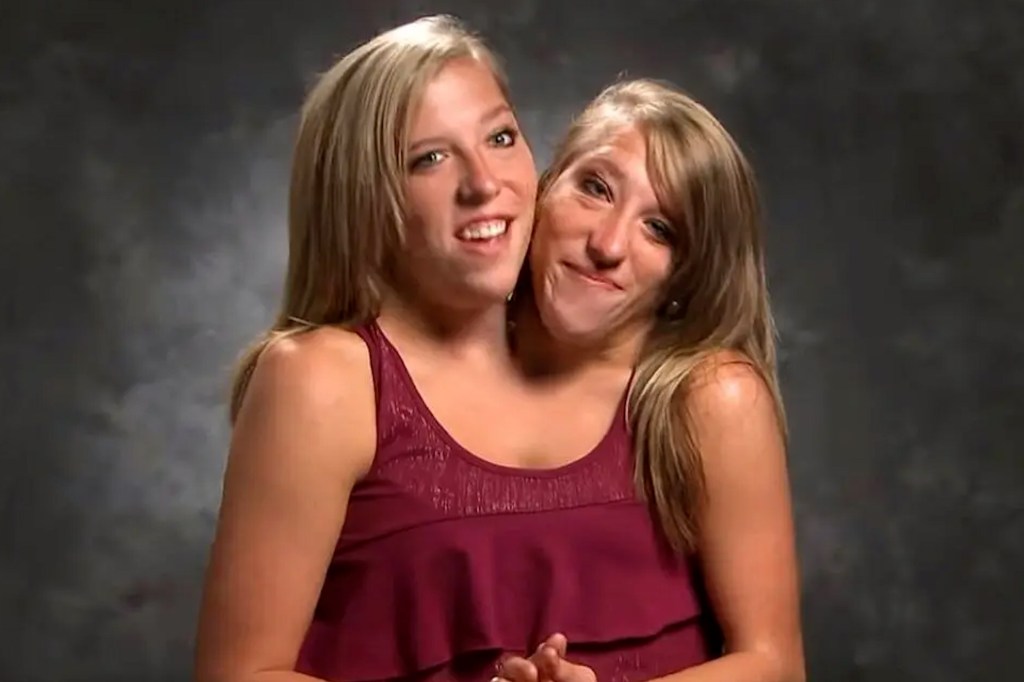 Video of Conjoined Twins: Could it be a Metaphor For or Against Trinity — As Three Persons in One&nbsp;Being